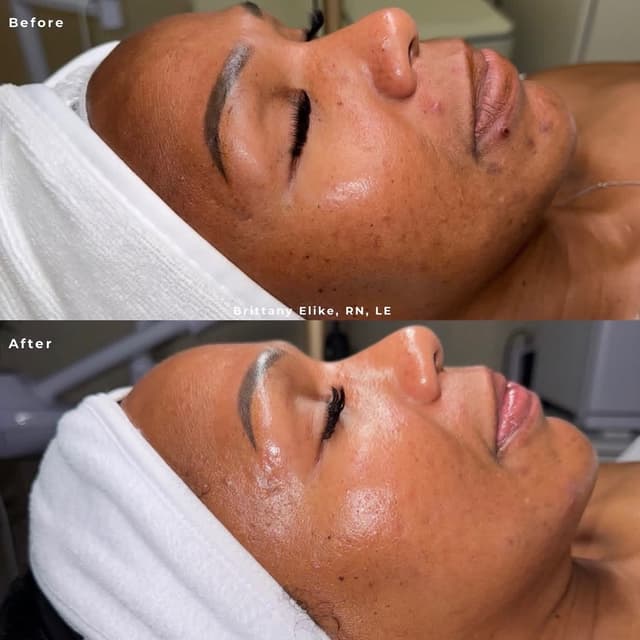 Acne Reset Program at Brittany Elike, RN, LE in Hoover, AL
