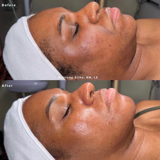 Advanced Microchanneling Series at Brittany Elike, RN, LE in Hoover, AL
