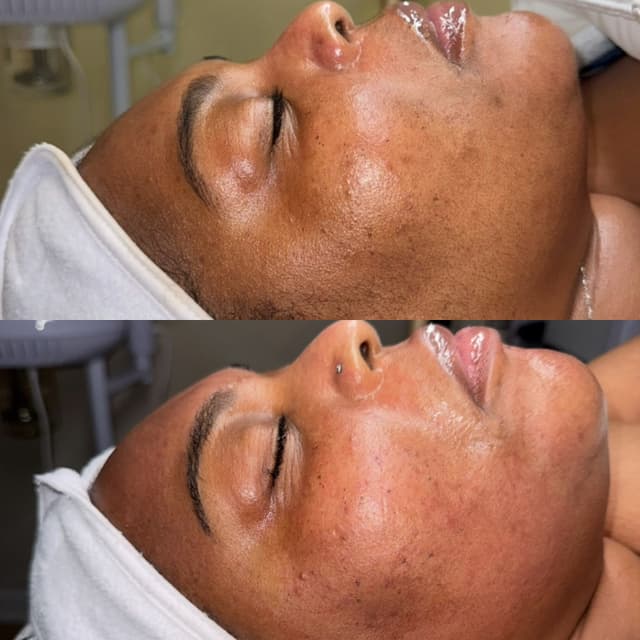 Signature Microchanneling Series at Brittany Elike, RN, LE in Hoover, AL